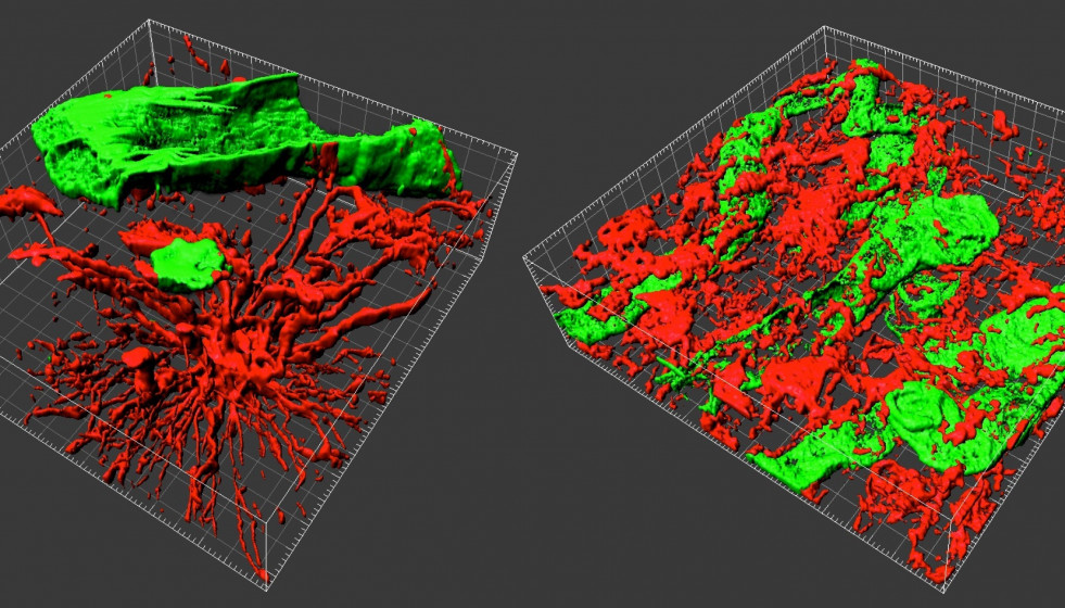 Recreación del tumor.