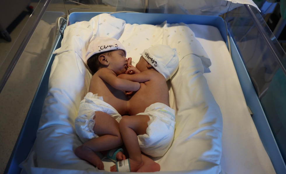 Las gemelas serán intervenidas en los próximos días para separar sus cuerpos